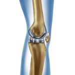 Knee Replacement Surgery