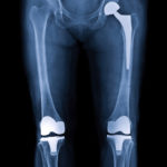 Joint Replacement