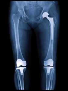 Joint Replacement