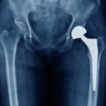 Joint Replacement Surgery