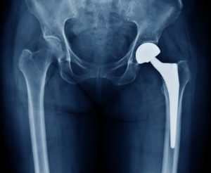 Joint Replacement Surgery