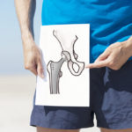 Total hip replacement