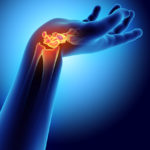 Carpal tunnel syndrome