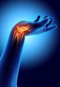 Carpal tunnel syndrome