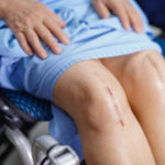 Asian senior or elderly old lady woman patient show her scars surgical total knee joint replacement Suture wound surgery arthroplasty on bed in nursing hospital ward : healthy strong medical concept.