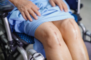 Asian senior or elderly old lady woman patient show her scars surgical total knee joint replacement Suture wound surgery arthroplasty on bed in nursing hospital ward : healthy strong medical concept.