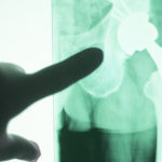 Xray of a hip joint replacement