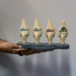 Doctor show anatomical model of knee displaying progression of knee osteoarthritis which ending up in Total Knee Replacement surgery. model of joint showing multiple stages of knee osteoarthritis
