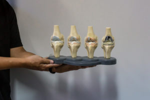 Doctor show anatomical model of knee displaying progression of knee osteoarthritis which ending up in Total Knee Replacement surgery. model of joint showing multiple stages of knee osteoarthritis