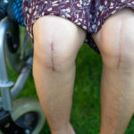A Patient showing his knee after total joint replacement surgery
