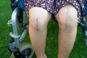 A Patient showing his knee after total joint replacement surgery