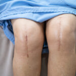 A patient knee after total knee replacement surgery