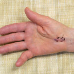 carpal tunnel surgery