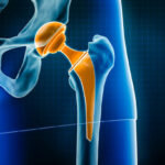 Hip prosthesis x-ray 3D rendering illustration. Total hip joint replacement surgery or arthroplasty, medical and healthcare, arthritis, pathology, science, osteology, orthopedics concepts.