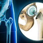 Femoral head hip prosthesis or implant x-ray with magnification or close-up. Total hip joint replacement surgery or arthroplasty 3D rendering illustration. Medical and healthcare, science concepts.