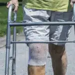 Knee Replacement Surgery Medical Patient Close-Up