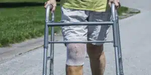 Knee Replacement Surgery Medical Patient Close-Up