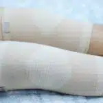 patient show her scars surgical total knee joint replacement