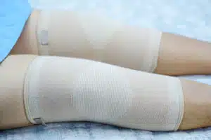 patient show her scars surgical total knee joint replacement