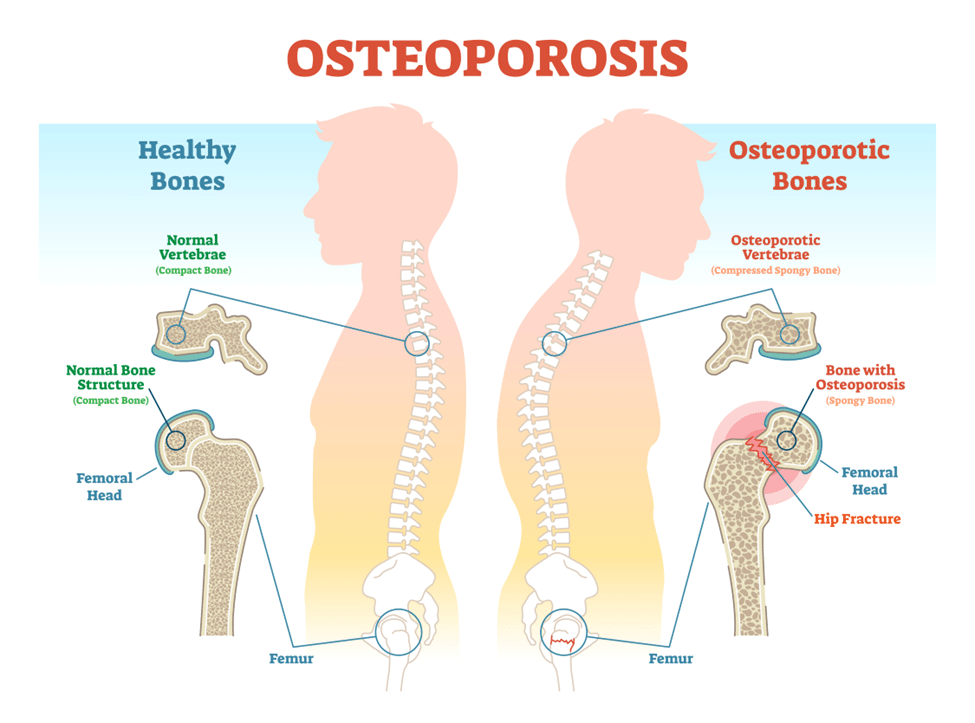 Diagram image of osteoporotic bones versus healthy bones. 